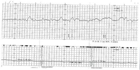 fetal heart tracing quiz.